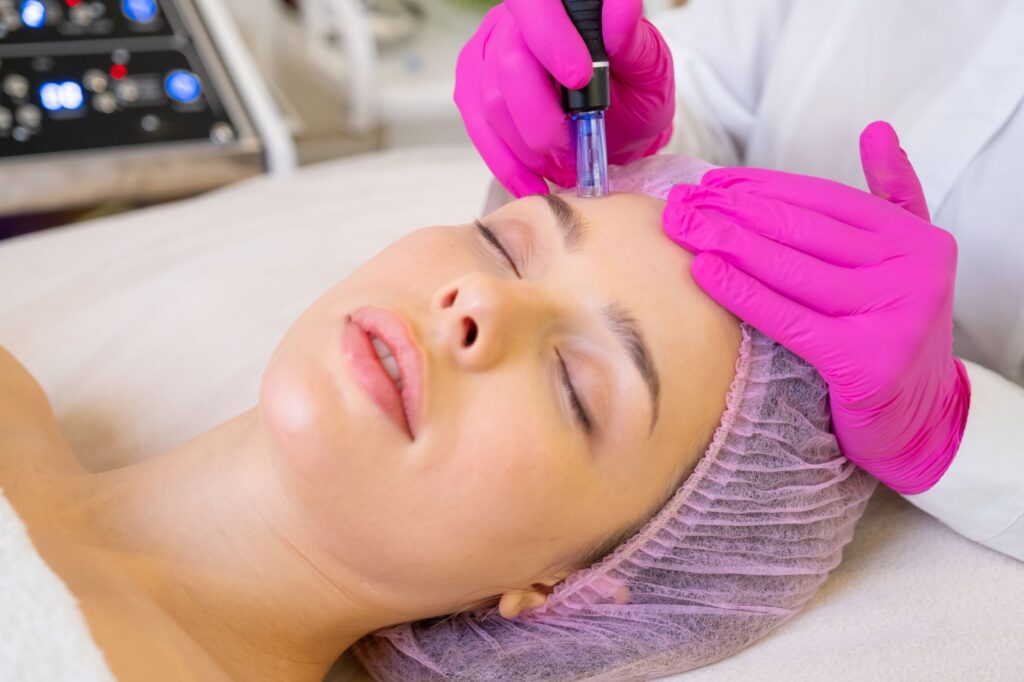 microneedling